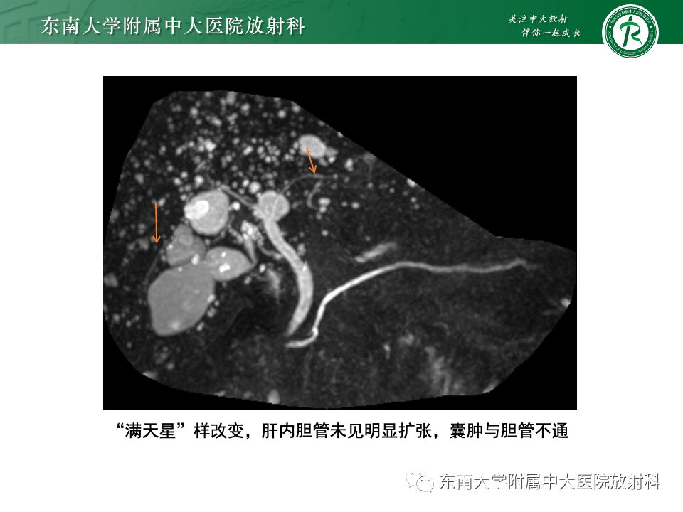 影像PPT - 【PPT】Caroli病-26