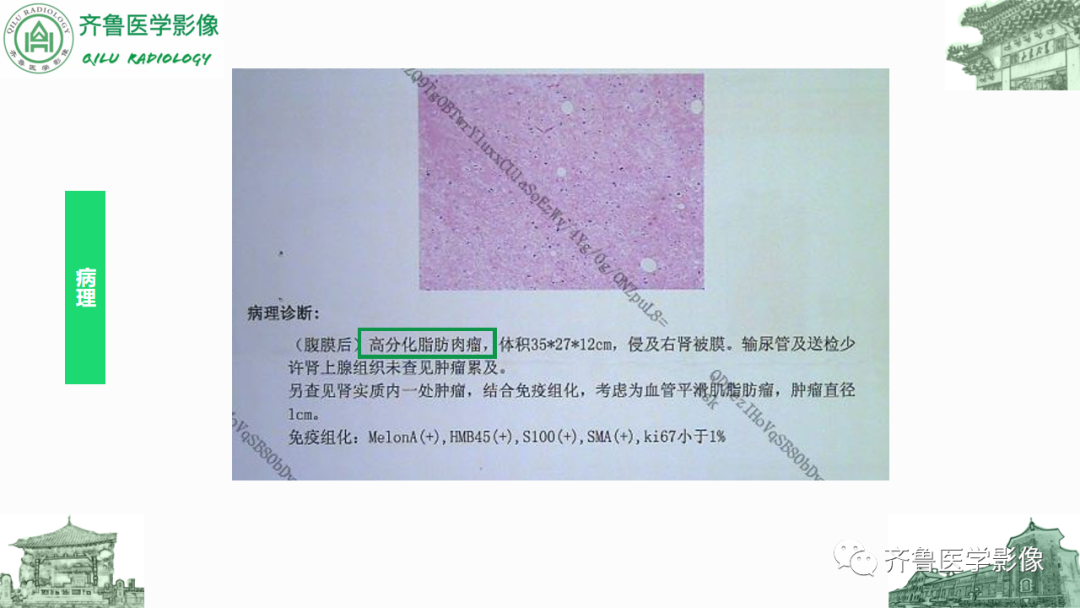 影像PPT - 【PPT】腹膜及腹膜后病变-5