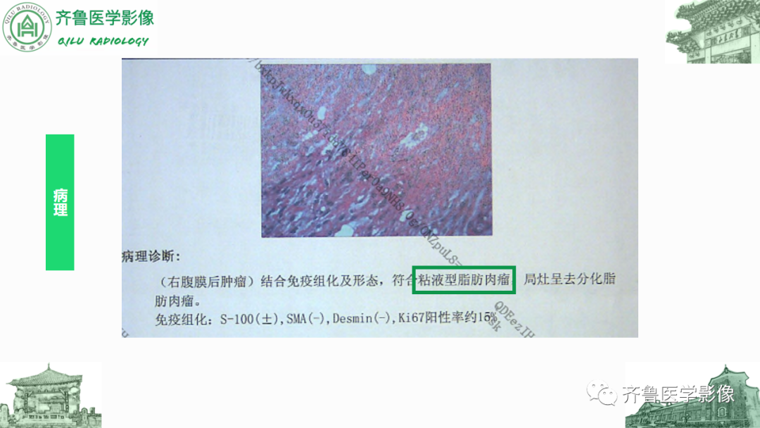 影像PPT - 【PPT】腹膜及腹膜后病变-9