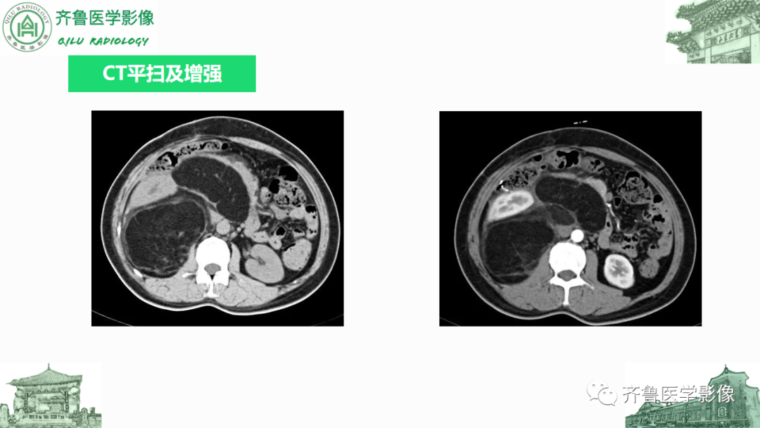 影像PPT - 【PPT】腹膜及腹膜后病变-14