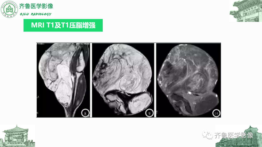 影像PPT - 【PPT】腹膜及腹膜后病变-15