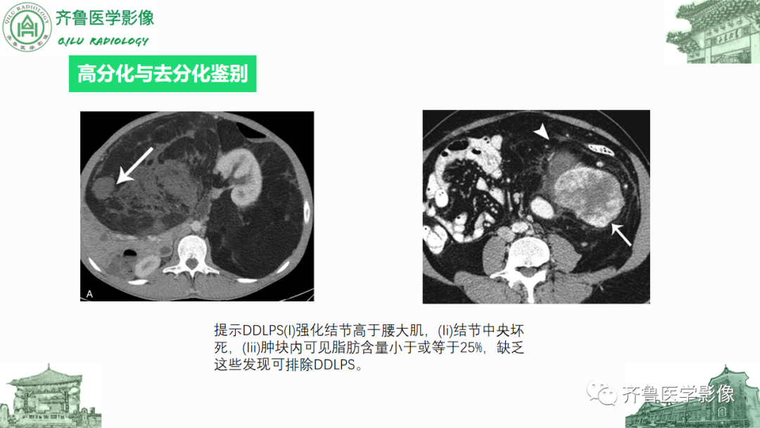 影像PPT - 【PPT】腹膜及腹膜后病变-21
