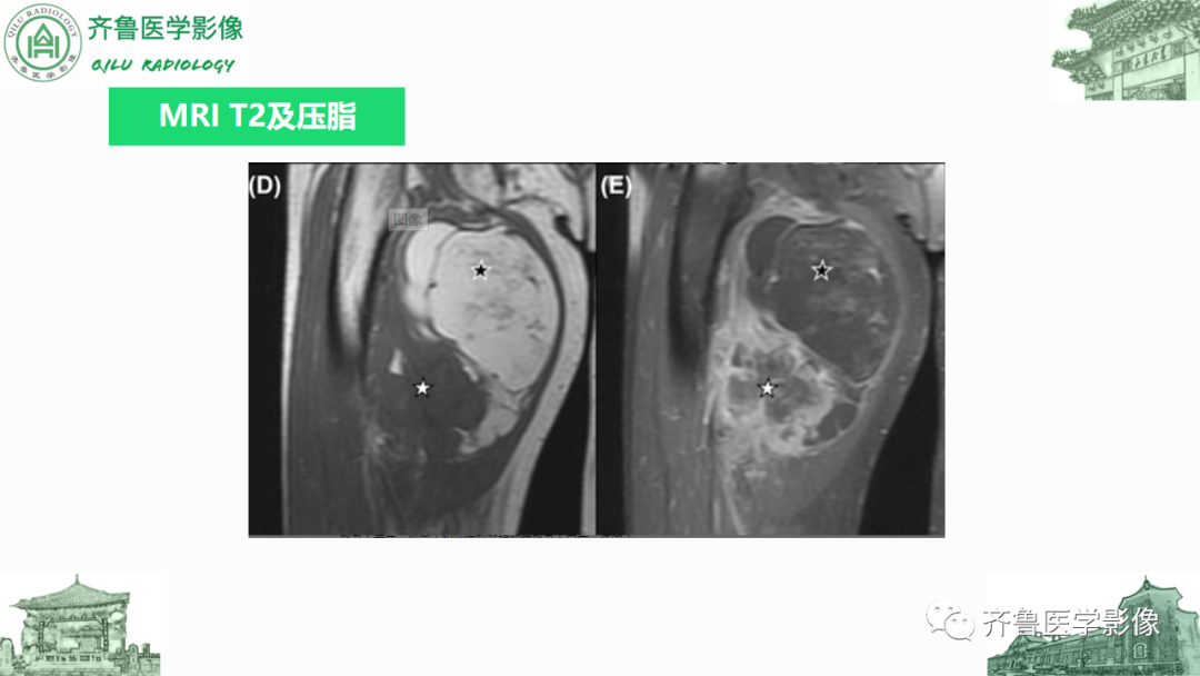 影像PPT - 【PPT】腹膜及腹膜后病变-20