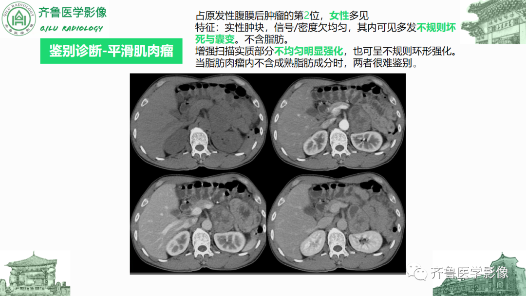 影像PPT - 【PPT】腹膜及腹膜后病变-27