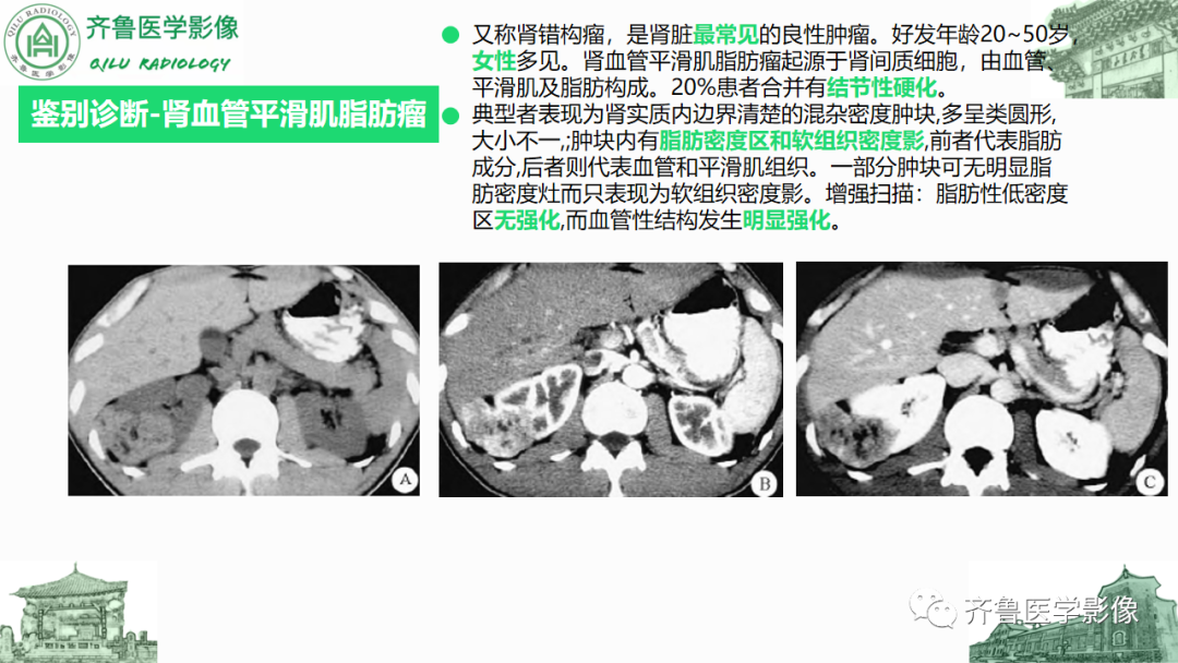 影像PPT - 【PPT】腹膜及腹膜后病变-28