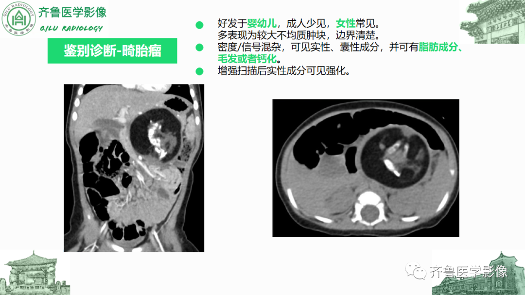 影像PPT - 【PPT】腹膜及腹膜后病变-26