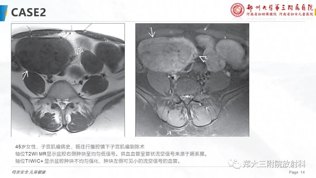 影像PPT - 【PPT】特殊生长方式的子宫肌瘤-14