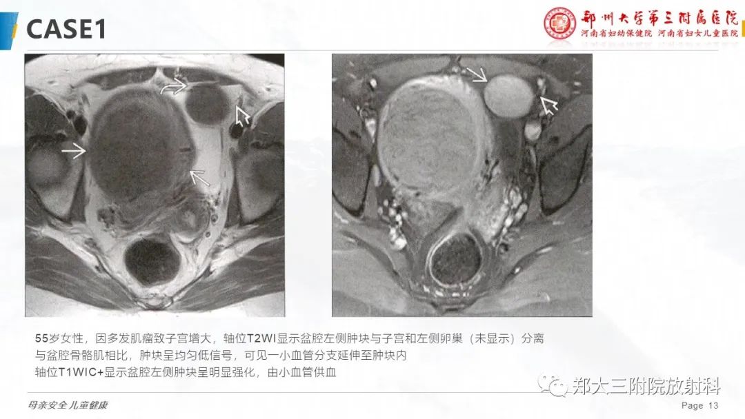 影像PPT - 【PPT】特殊生长方式的子宫肌瘤-13