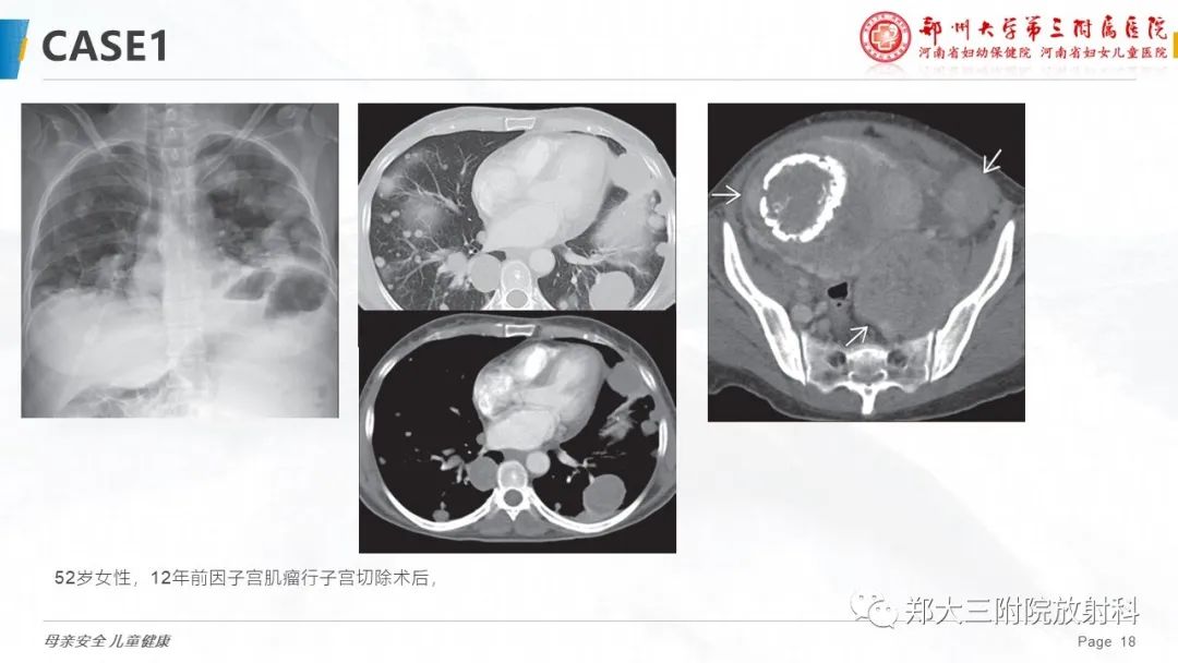 影像PPT - 【PPT】特殊生长方式的子宫肌瘤-18