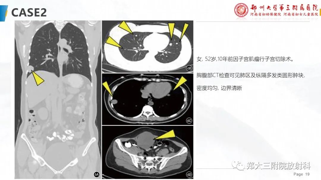 影像PPT - 【PPT】特殊生长方式的子宫肌瘤-19
