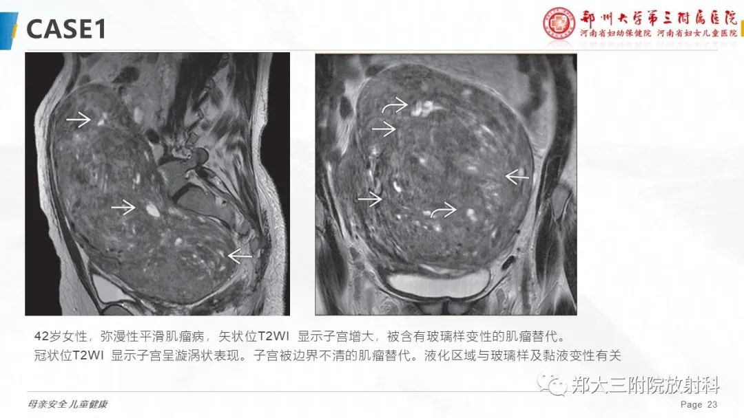 影像PPT - 【PPT】特殊生长方式的子宫肌瘤-23