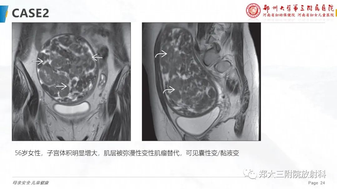 影像PPT - 【PPT】特殊生长方式的子宫肌瘤-24
