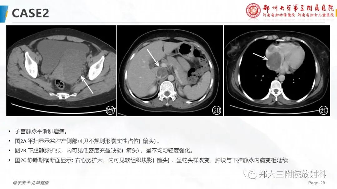 影像PPT - 【PPT】特殊生长方式的子宫肌瘤-29