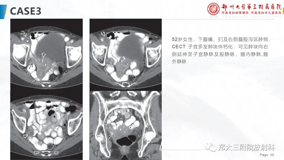 影像PPT - 【PPT】特殊生长方式的子宫肌瘤-30