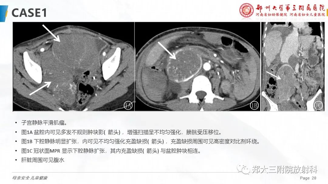 影像PPT - 【PPT】特殊生长方式的子宫肌瘤-28