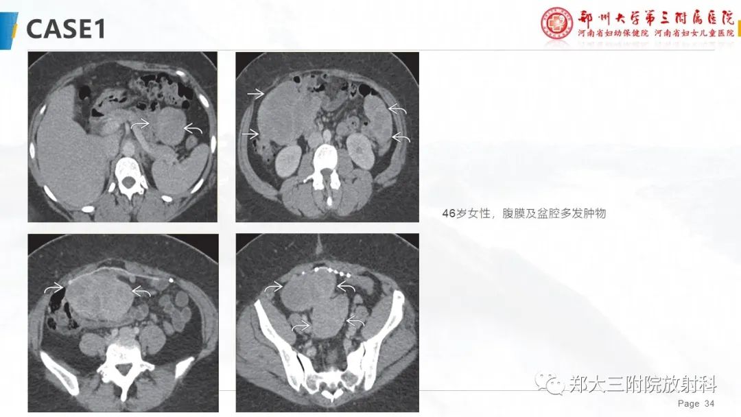 影像PPT - 【PPT】特殊生长方式的子宫肌瘤-34