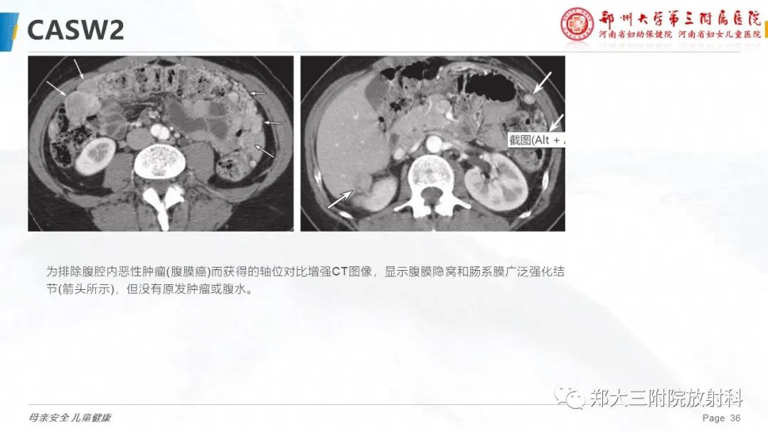 影像PPT - 【PPT】特殊生长方式的子宫肌瘤-36