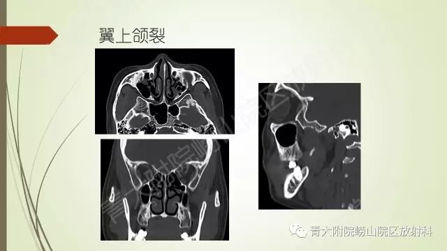 影像PPT - 【PPT】翼腭窝相通孔道-5