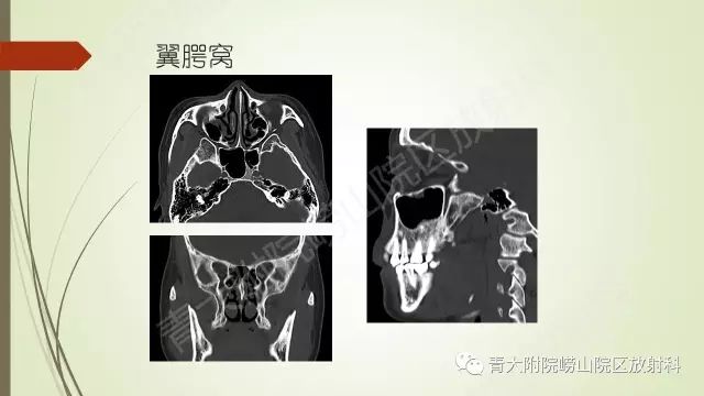 影像PPT - 【PPT】翼腭窝相通孔道-4