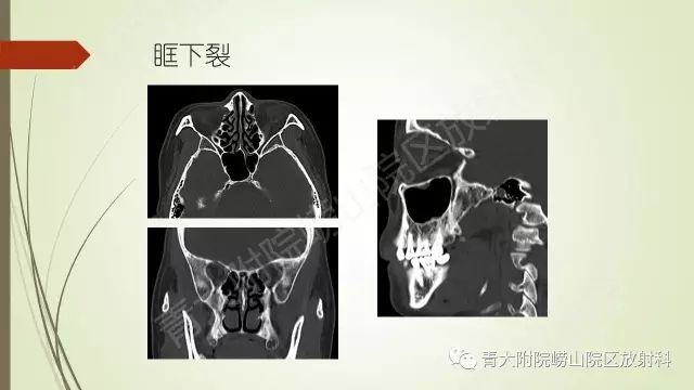 影像PPT - 【PPT】翼腭窝相通孔道-6