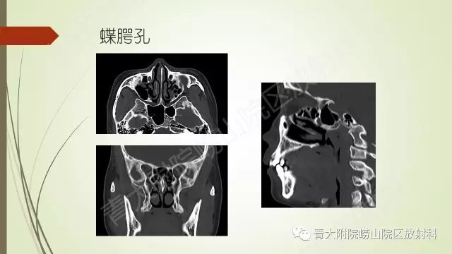 影像PPT - 【PPT】翼腭窝相通孔道-7