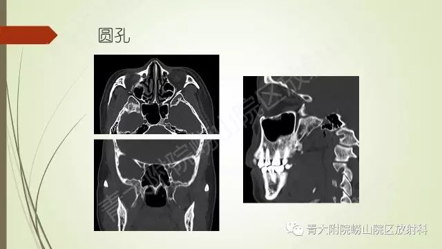 影像PPT - 【PPT】翼腭窝相通孔道-8