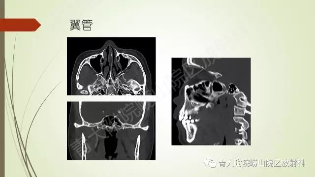 影像PPT - 【PPT】翼腭窝相通孔道-9