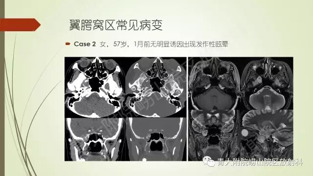 影像PPT - 【PPT】翼腭窝相通孔道-13