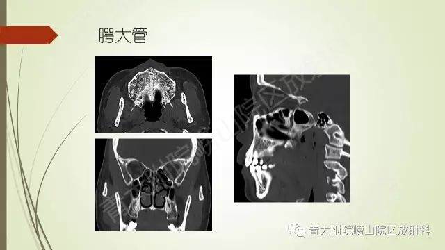 影像PPT - 【PPT】翼腭窝相通孔道-10
