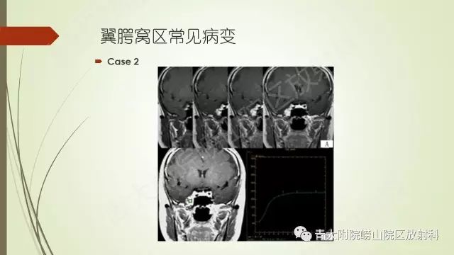 影像PPT - 【PPT】翼腭窝相通孔道-14
