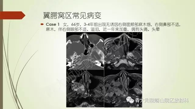 影像PPT - 【PPT】翼腭窝相通孔道-11