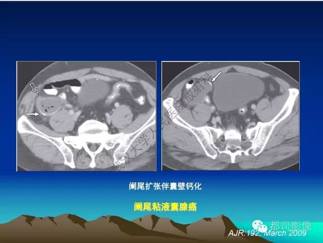 影像PPT - 【PPT】胃肠道囊性病变的影像学诊断-19