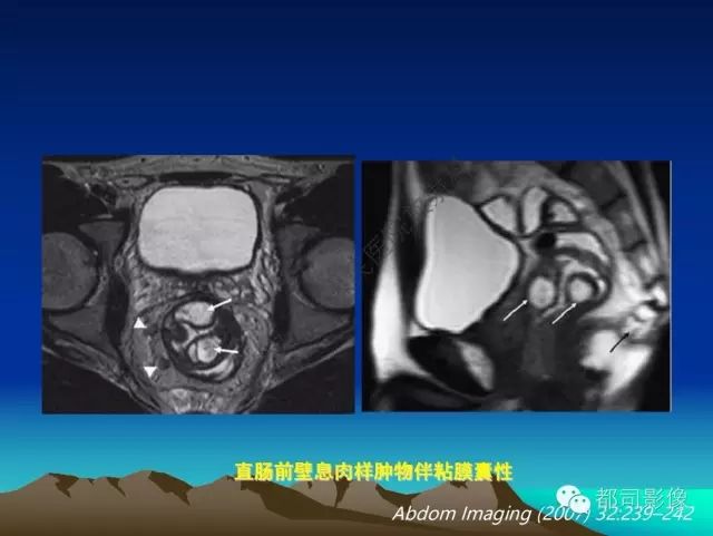 影像PPT - 【PPT】胃肠道囊性病变的影像学诊断-41