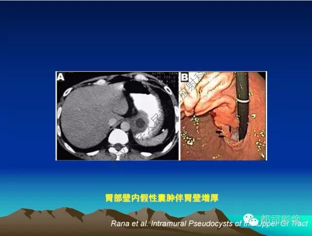 影像PPT - 【PPT】胃肠道囊性病变的影像学诊断-44