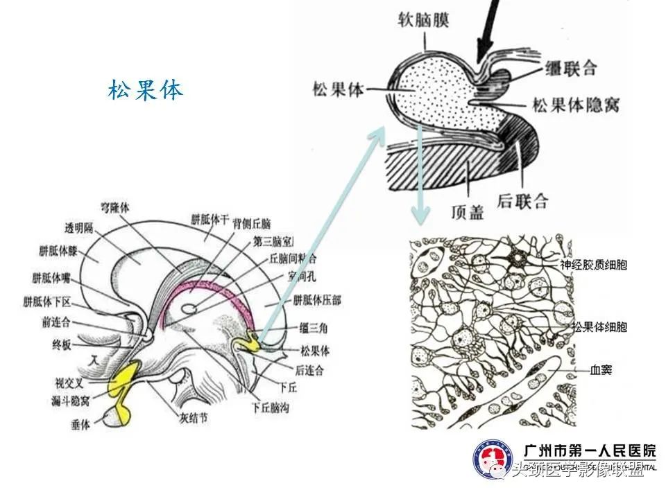 影像PPT - 【PPT】颅内生殖细胞瘤影像诊断及鉴别-9