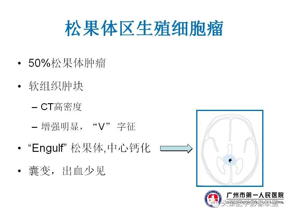 影像PPT - 【PPT】颅内生殖细胞瘤影像诊断及鉴别-10