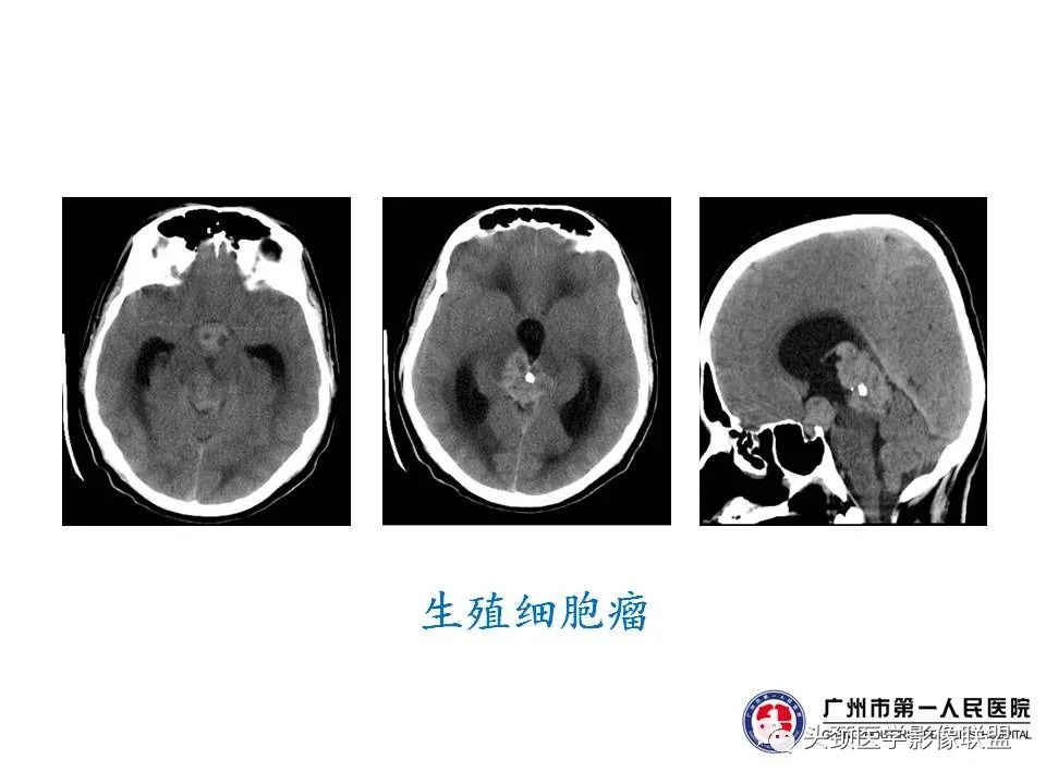 影像PPT - 【PPT】颅内生殖细胞瘤影像诊断及鉴别-12