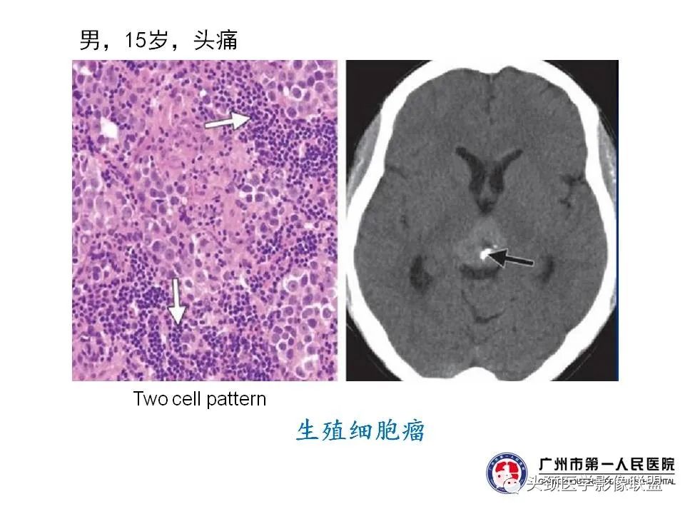 影像PPT - 【PPT】颅内生殖细胞瘤影像诊断及鉴别-11