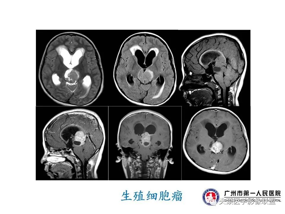 影像PPT - 【PPT】颅内生殖细胞瘤影像诊断及鉴别-14