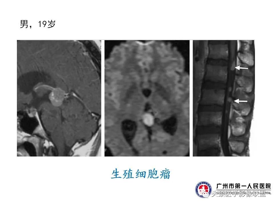 影像PPT - 【PPT】颅内生殖细胞瘤影像诊断及鉴别-15