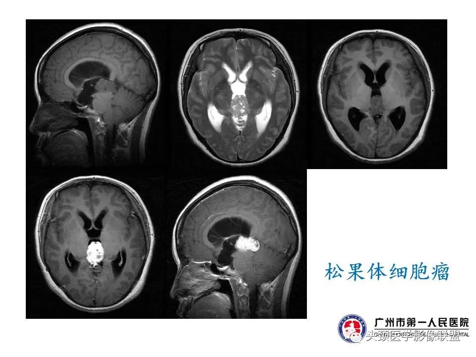 影像PPT - 【PPT】颅内生殖细胞瘤影像诊断及鉴别-17