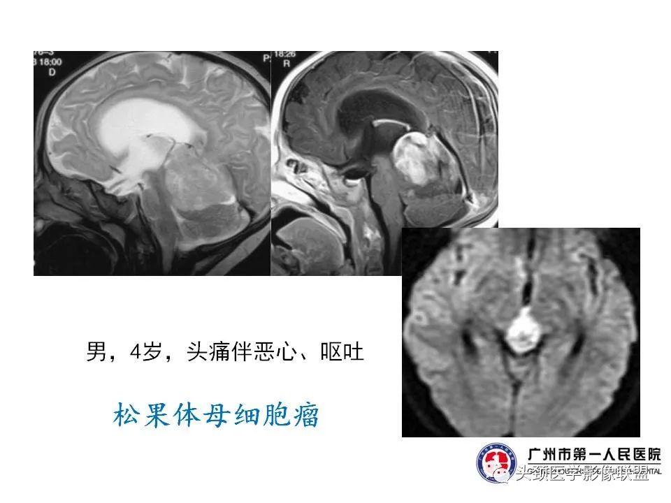 影像PPT - 【PPT】颅内生殖细胞瘤影像诊断及鉴别-19