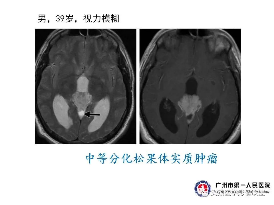 影像PPT - 【PPT】颅内生殖细胞瘤影像诊断及鉴别-18
