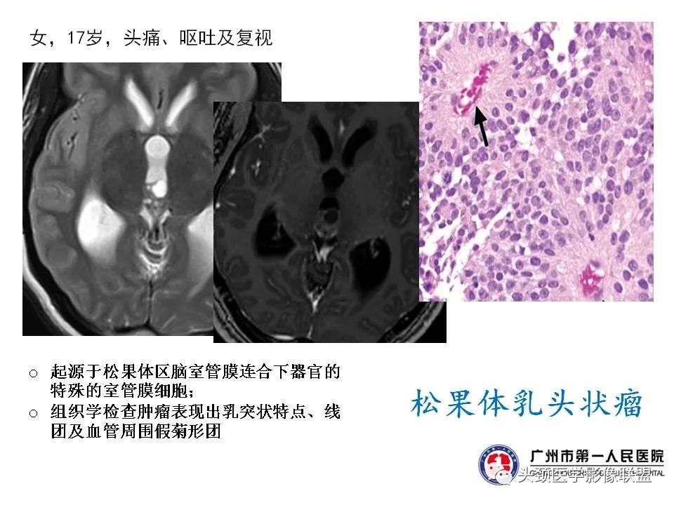 影像PPT - 【PPT】颅内生殖细胞瘤影像诊断及鉴别-20