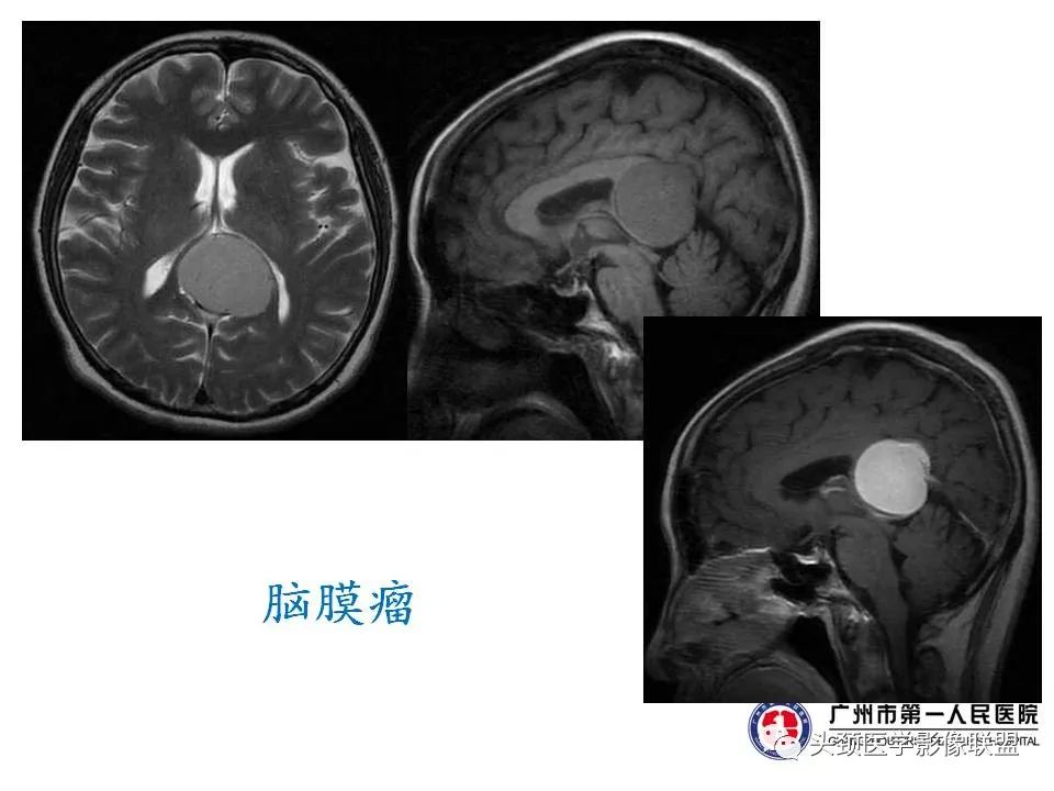 影像PPT - 【PPT】颅内生殖细胞瘤影像诊断及鉴别-21