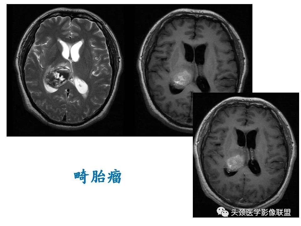 影像PPT - 【PPT】颅内生殖细胞瘤影像诊断及鉴别-25