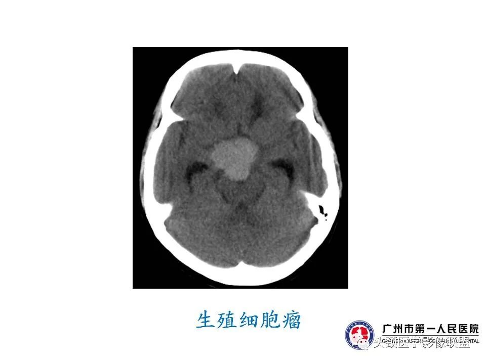 影像PPT - 【PPT】颅内生殖细胞瘤影像诊断及鉴别-28