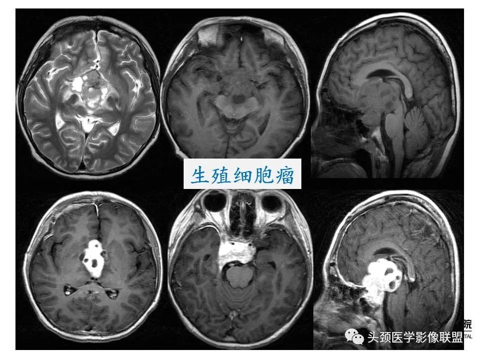 影像PPT - 【PPT】颅内生殖细胞瘤影像诊断及鉴别-29