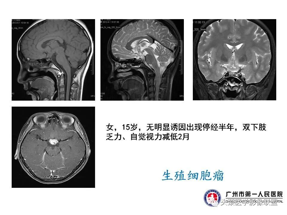 影像PPT - 【PPT】颅内生殖细胞瘤影像诊断及鉴别-30