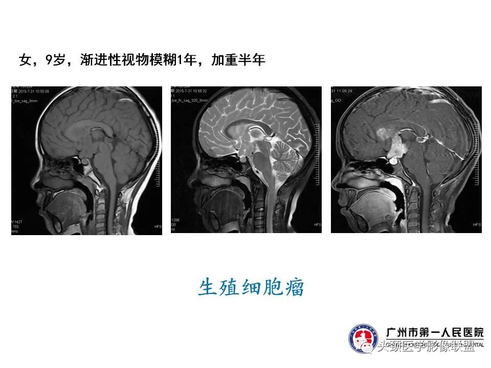 影像PPT - 【PPT】颅内生殖细胞瘤影像诊断及鉴别-31
